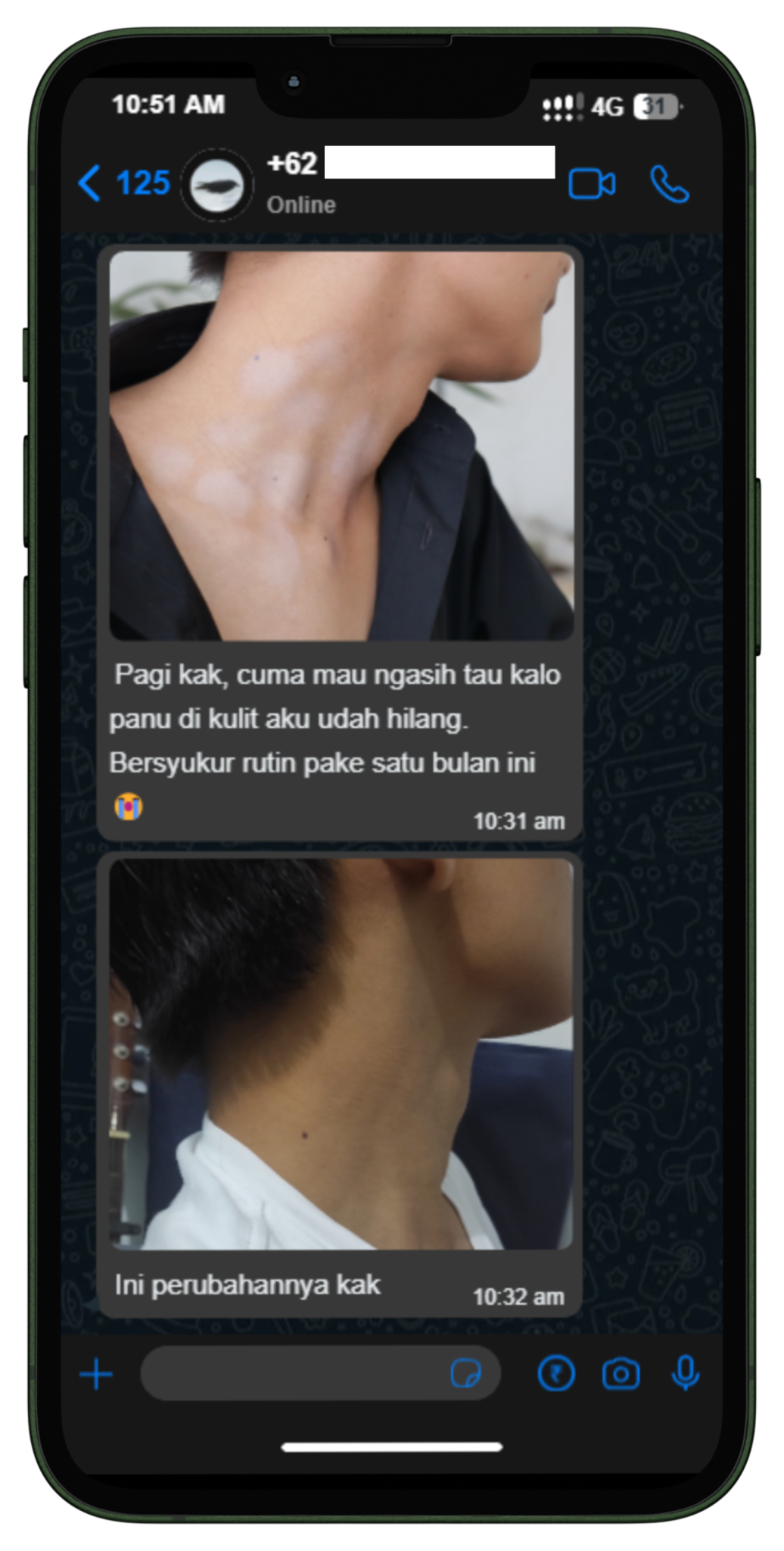 Testimoni WhatsApp pelanggan Mouluss — panu di kulit sudah hilang
