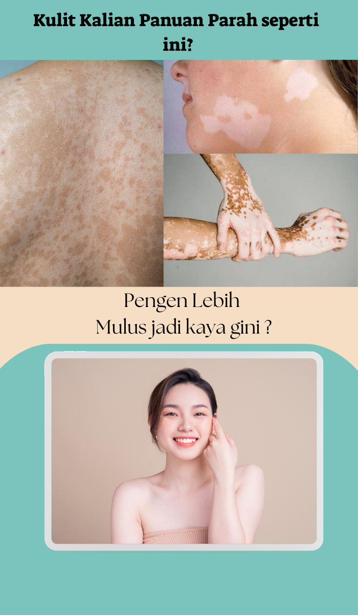 penyebab panu susah hilang di kulit